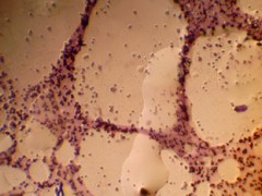 Imagen de microscopio Citología de un tumor cutáneo. LIPOMA